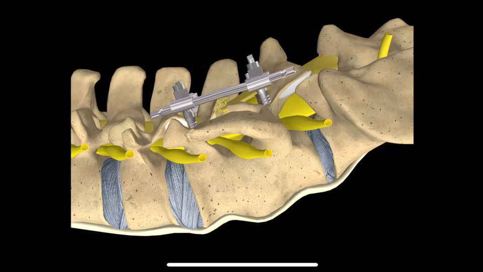 Transforaminal Lumbar interbody fusion with cages Goals